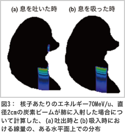 重粒子線治療シミュレーション