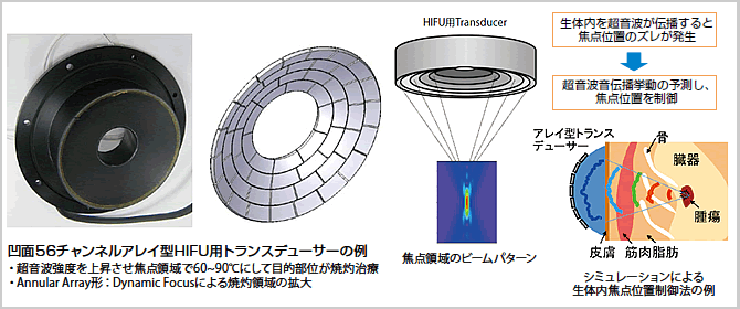 凹面56チャンネルアレイ型HIFU用トランスデューサーの例