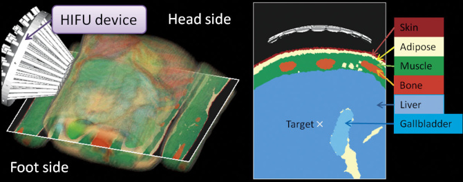 Figure 1 : HIFU simulation